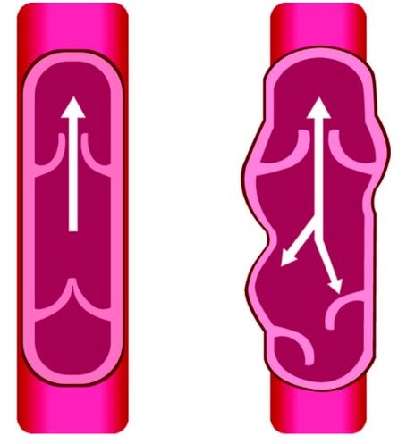 Patologia venelor