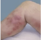 Diagnosticul și complicațiile varicelor