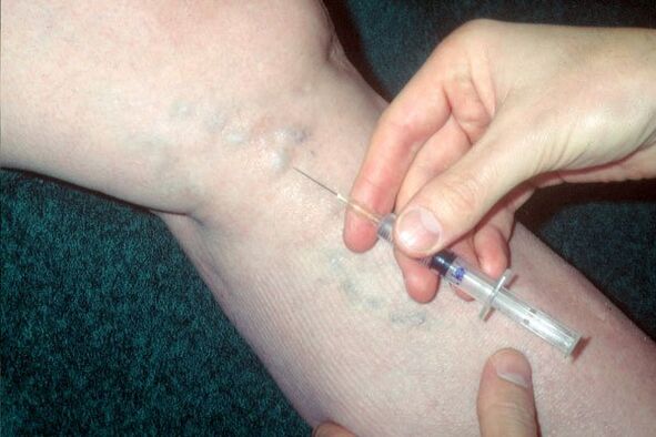 scleroterapie pentru vene varicoase