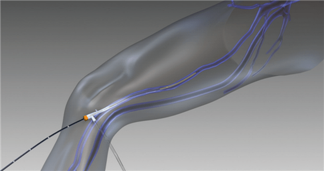 obliterarea prin radiofrecvență pentru vene varicoase