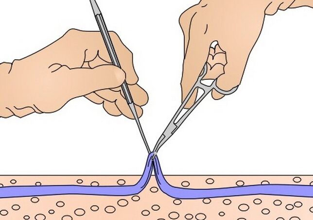 striparea venelor pentru vene varicoase
