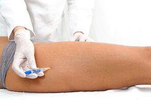 scleroterapia ca metodă de tratare a venelor varicoase