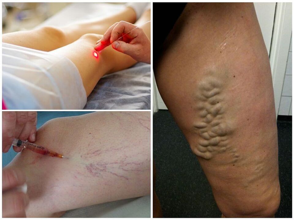 Metode de tratament nechirurgical al venelor varicoase ale picioarelor