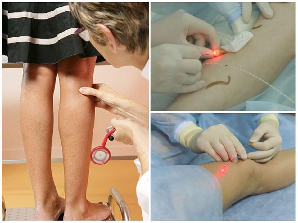 Progresul procedurii de coagulare cu laser a venelor varicoase de pe picioare